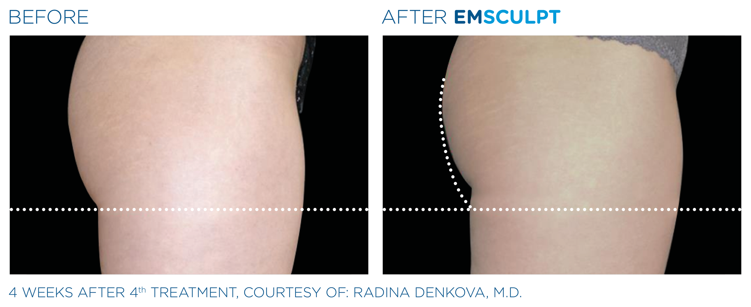 Emsculpt_PIC_Ba-card-female-buttock-015_EN100.png