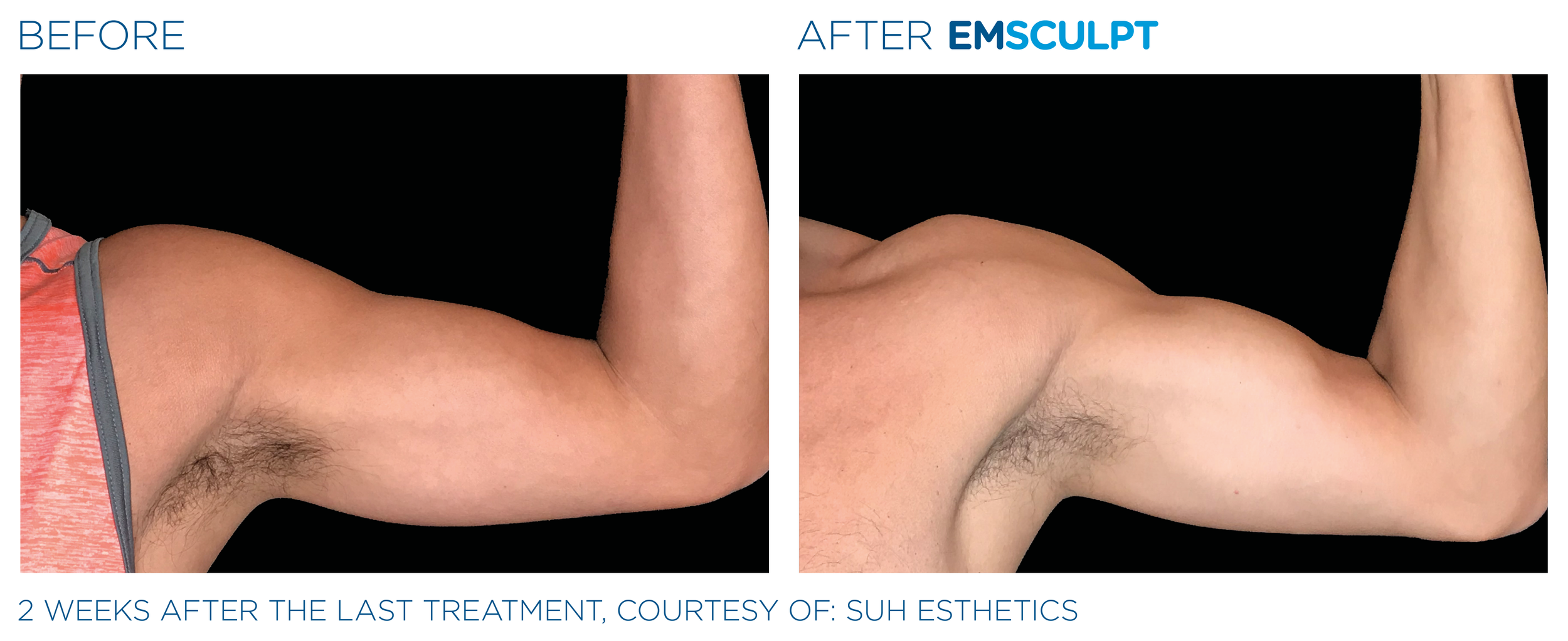 Emsculpt_PIC_Ba-card-male-arms-121_EN100.png