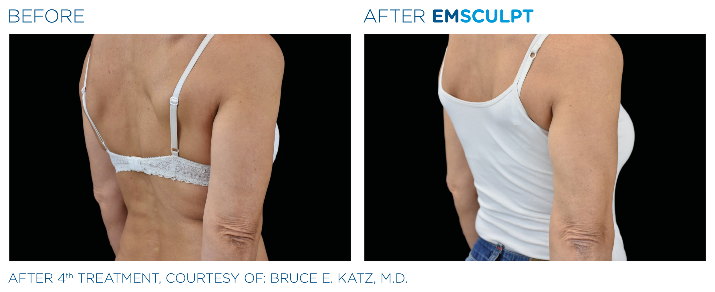 Emsculpt_PIC_Ba-card-female-arms-086_EN100.png