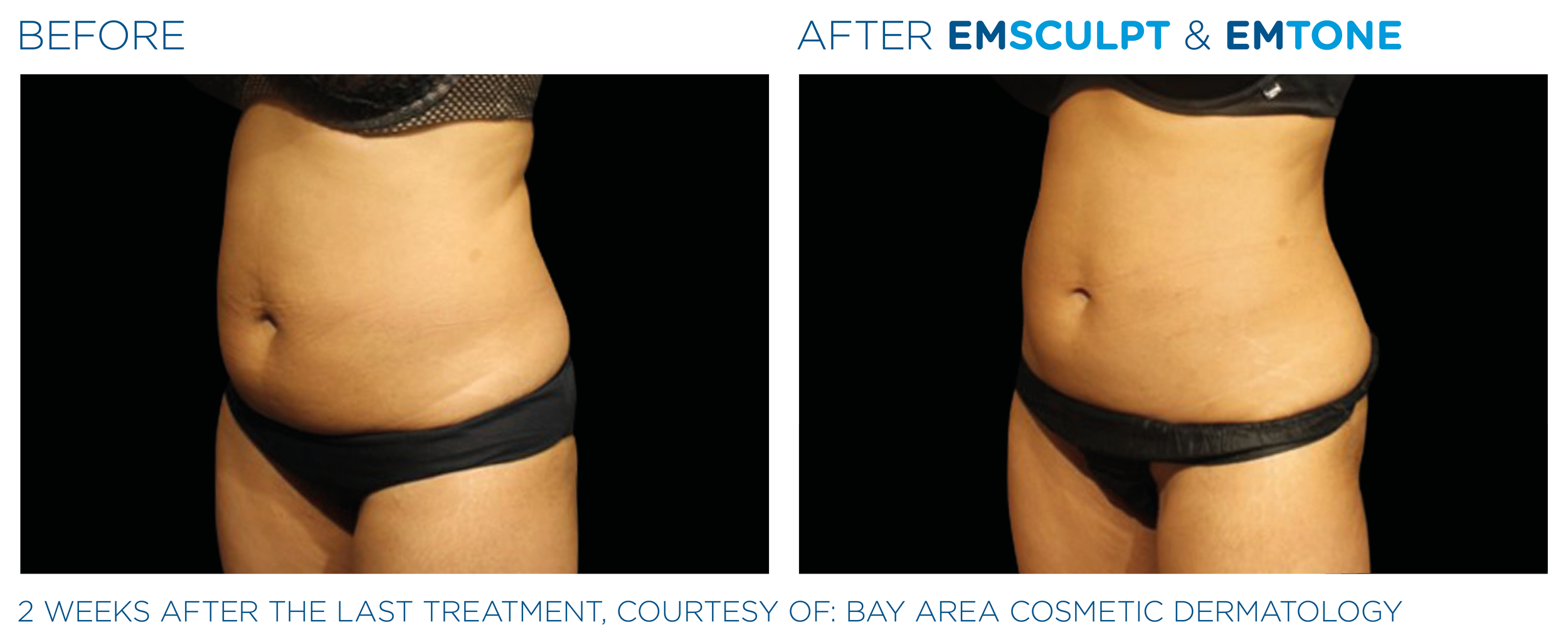 Emsculpt_Emtone_PIC_Ba-card-female-abdomen-001_EN100.png