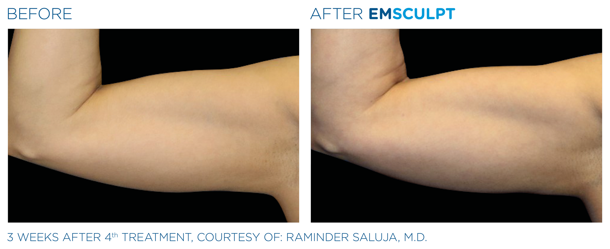 Emsculpt_PIC_Ba-card-female-arms-075_EN100.png