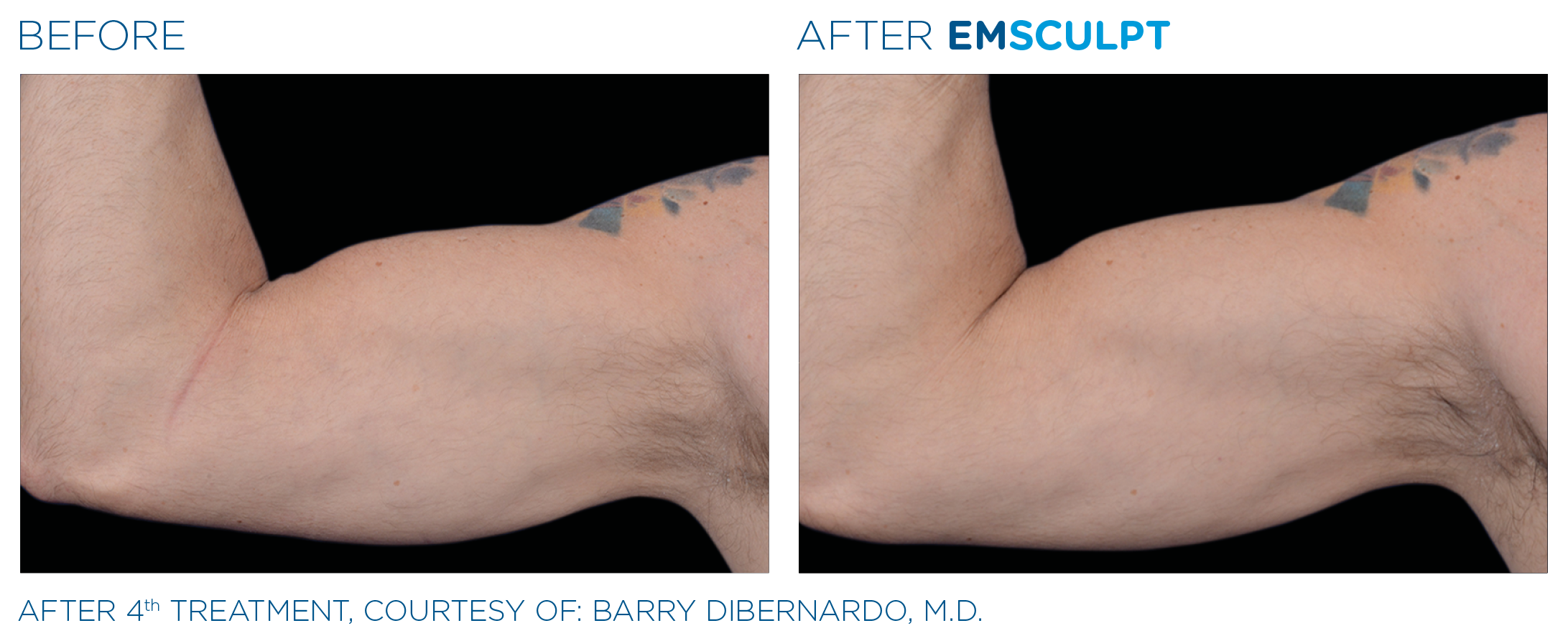 Emsculpt_PIC_Ba-card-male-arms-095_EN100.png