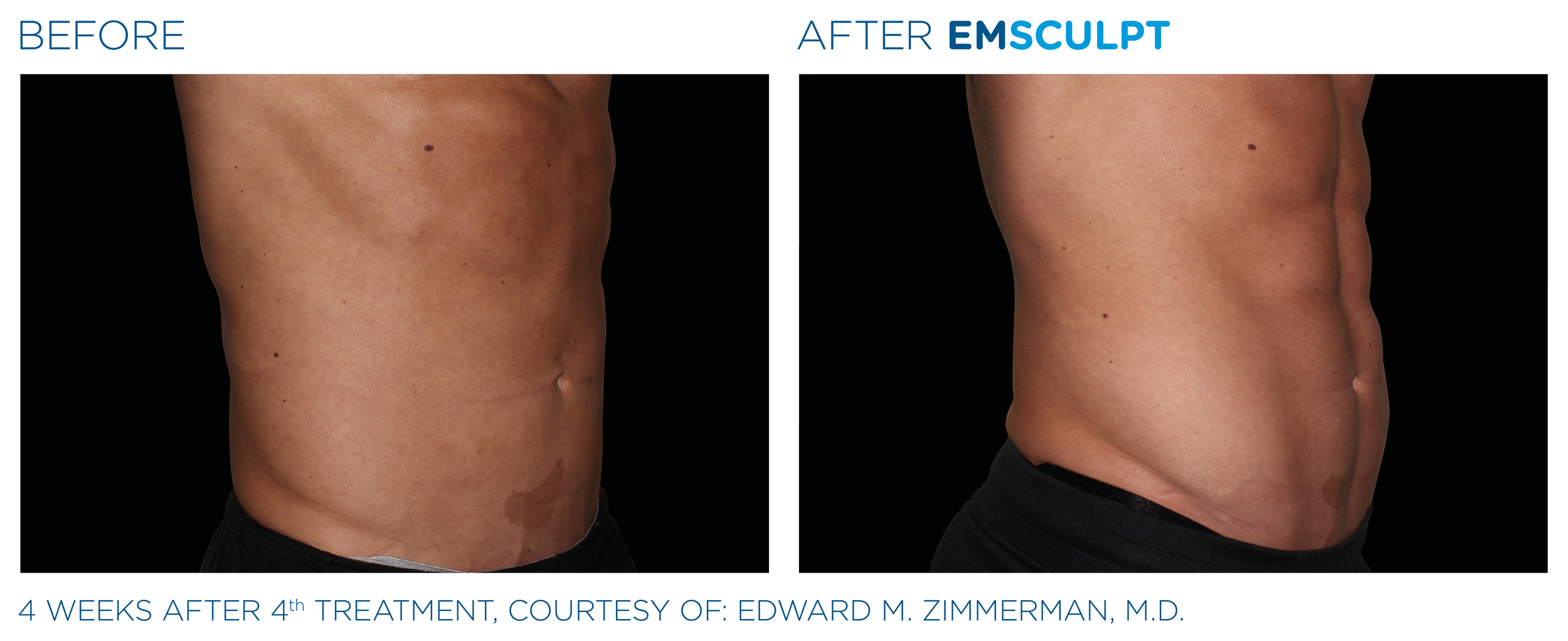 Emsculpt_PIC_Ba-card-male-abdomen-036_ENUS100.png