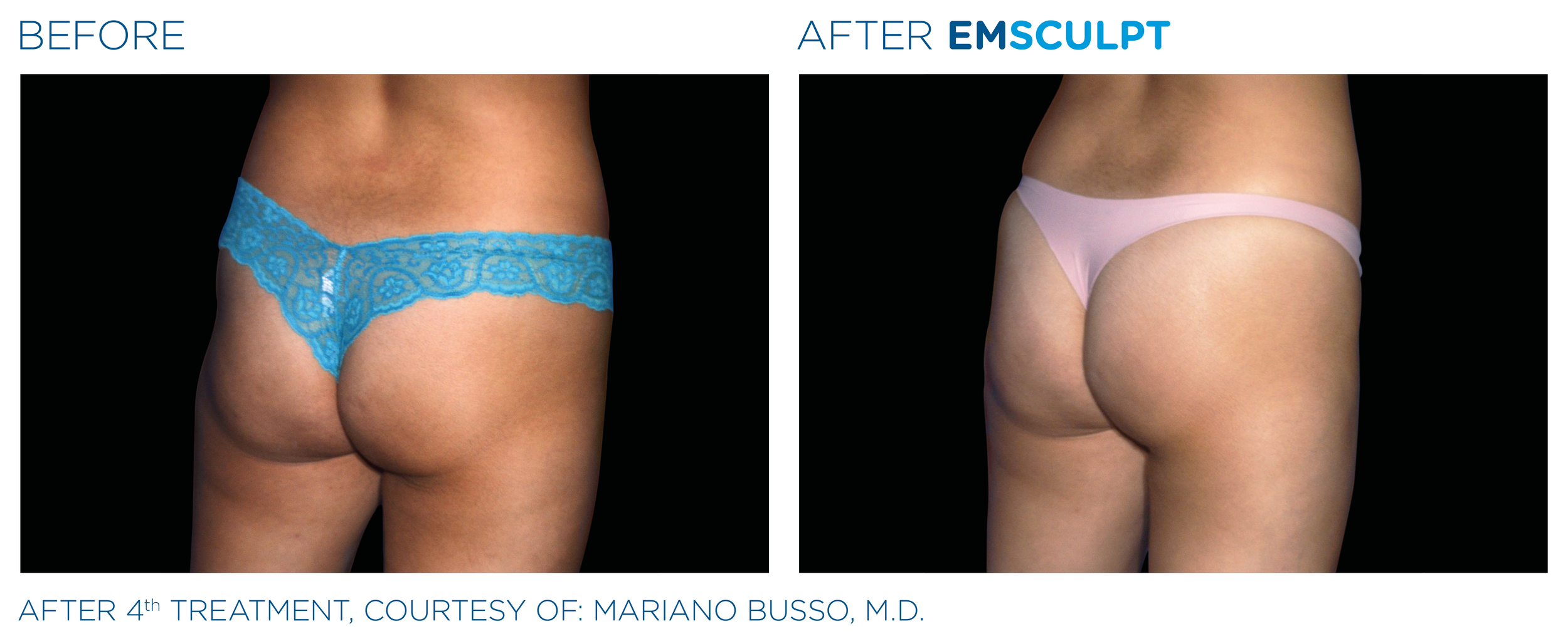 Emsculpt_PIC_Ba-card-female-buttock-012_EN100.png