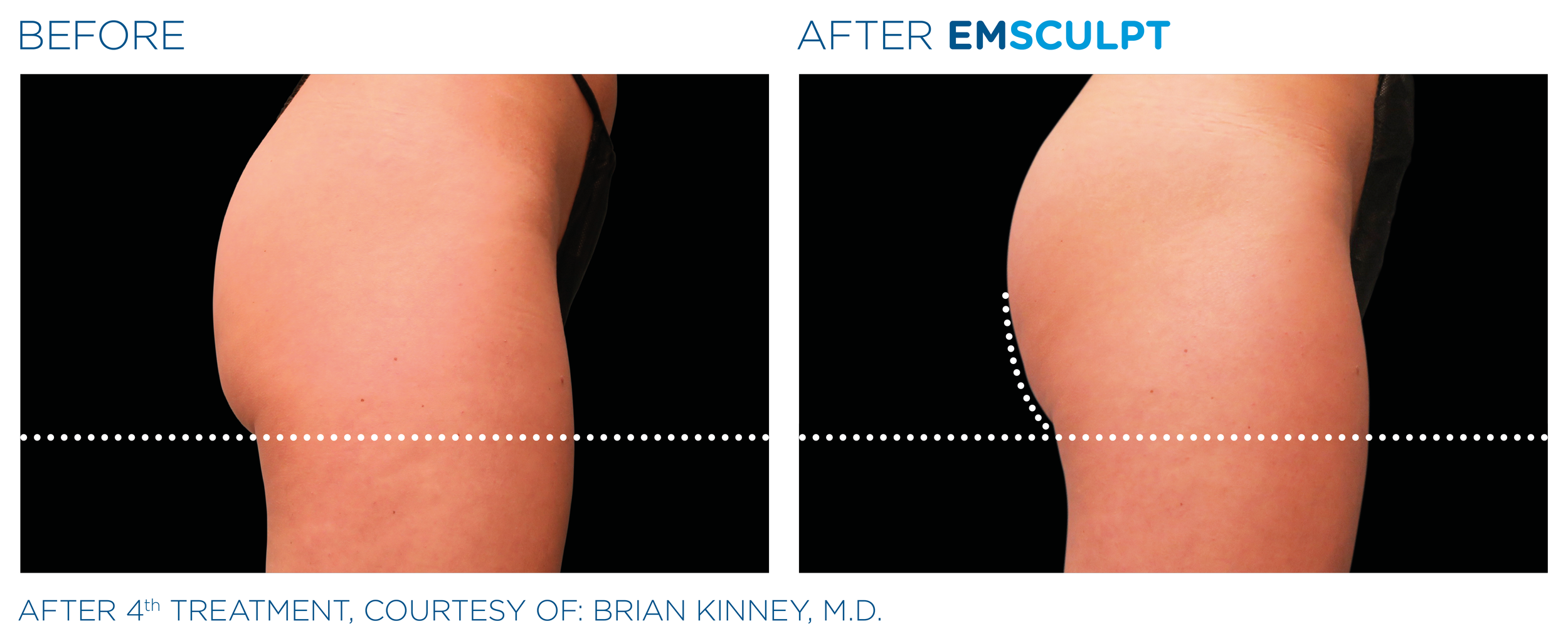 Emsculpt_PIC_Ba-card-female-buttock-016_EN100.png