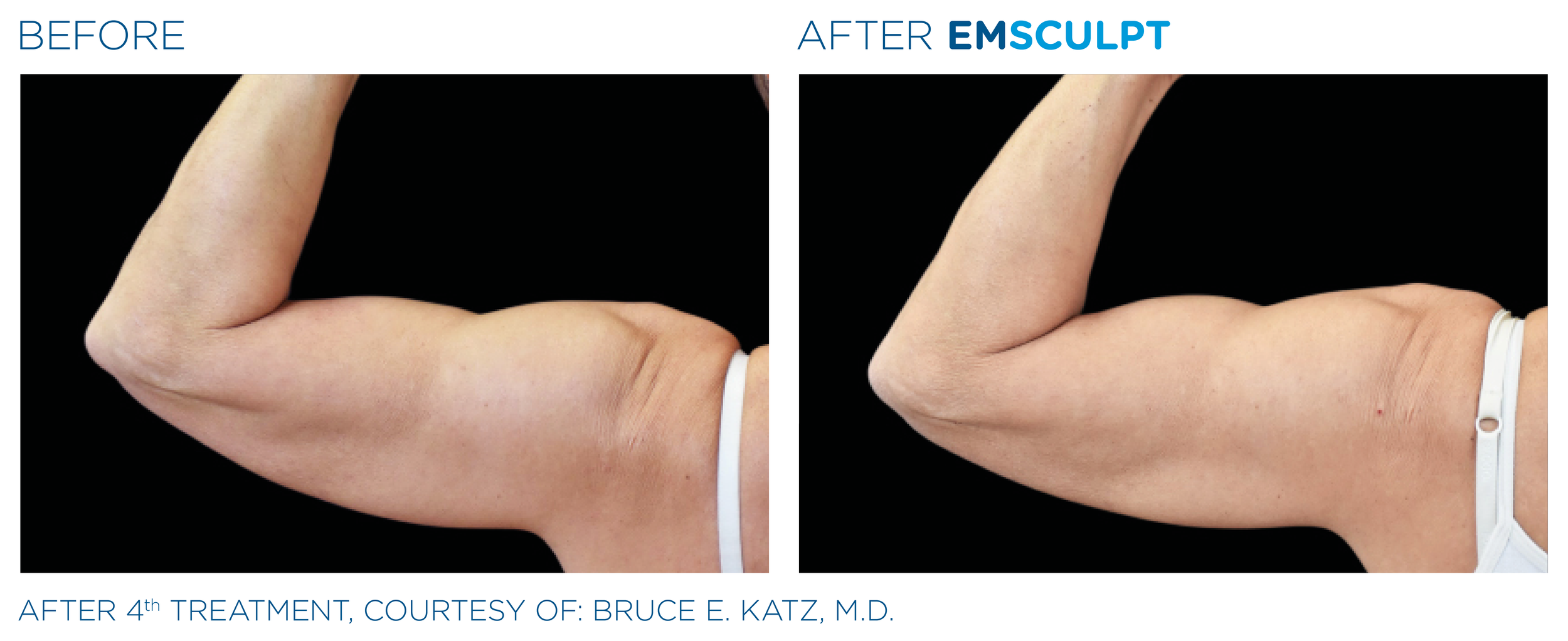 Emsculpt_PIC_Ba-card-female-arms-080_EN100.png
