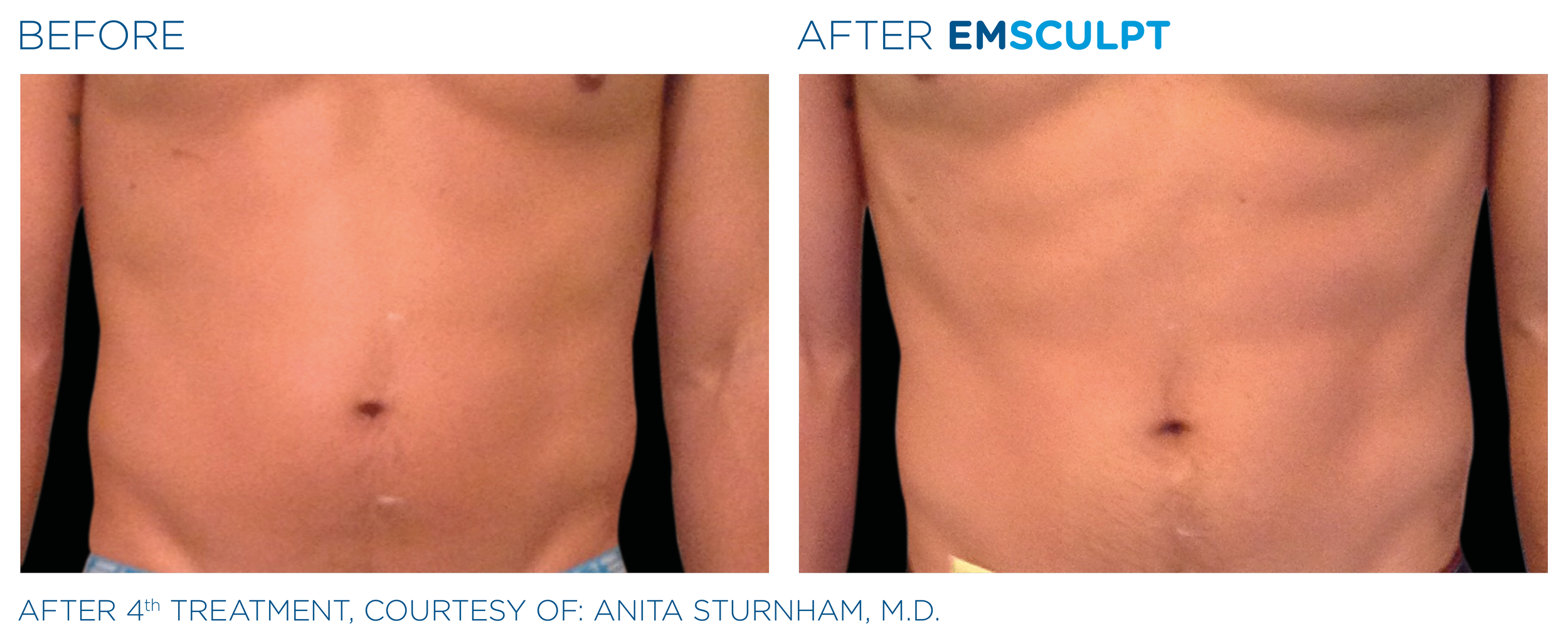 Emsculpt_PIC_Ba-card-male-abdomen-013_EN100.png