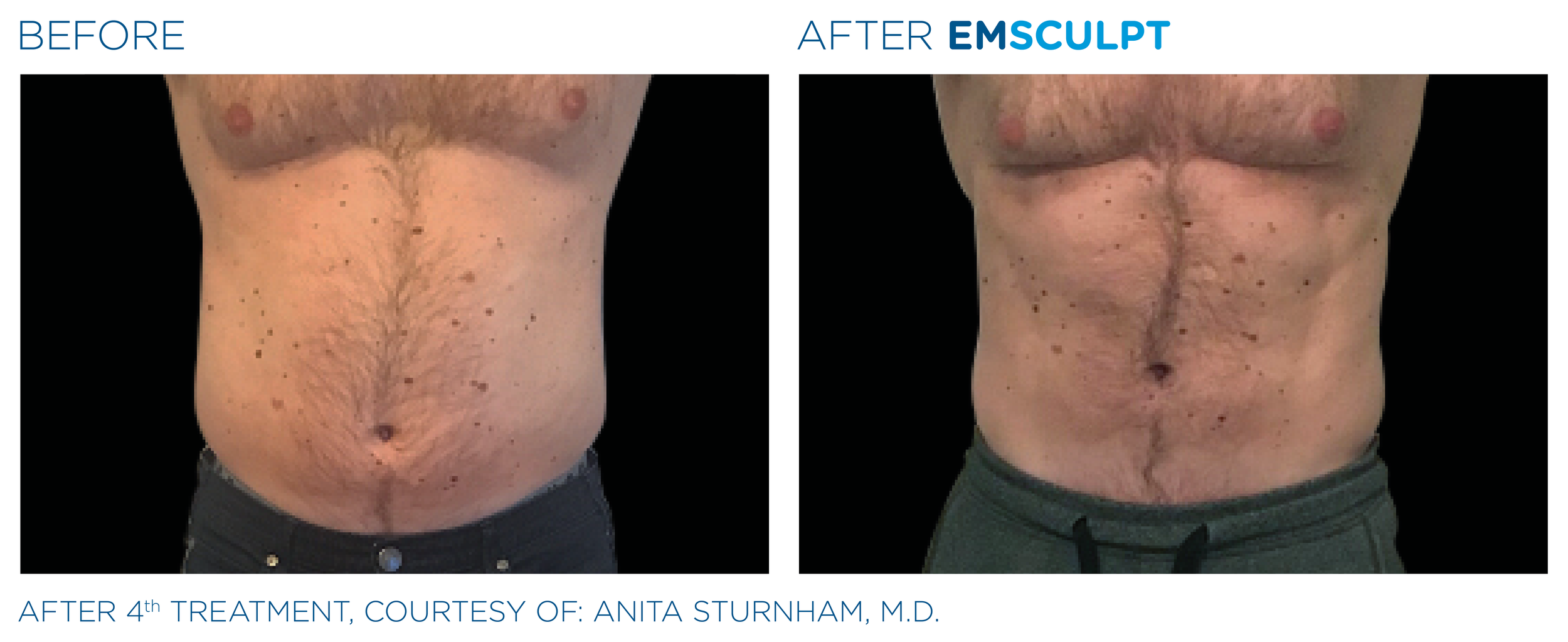 Emsculpt_PIC_Ba-card-male-abdomen-007_EN100.png