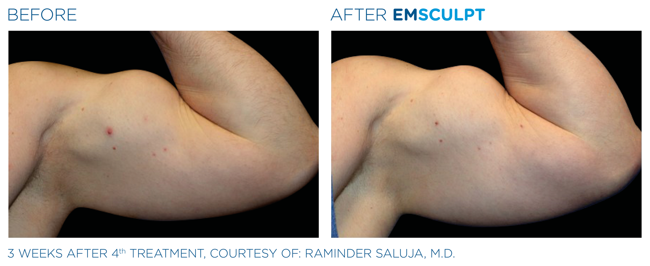 Emsculpt_PIC_Ba-card-male-arms-074_EN100.png