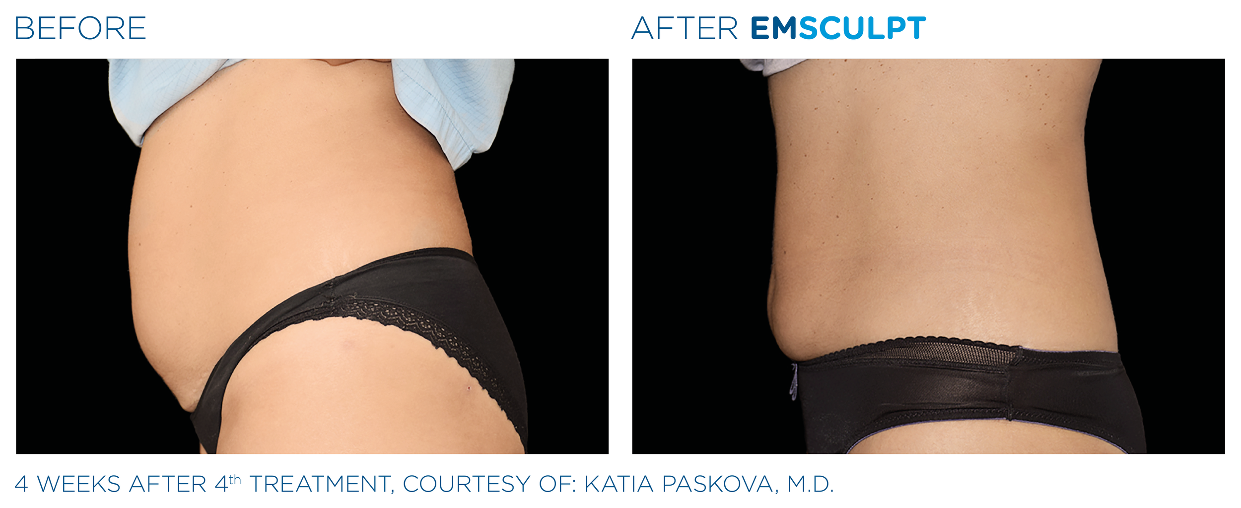 Emsculpt_PIC_Ba-card-female-abdomen-045_EN100.png