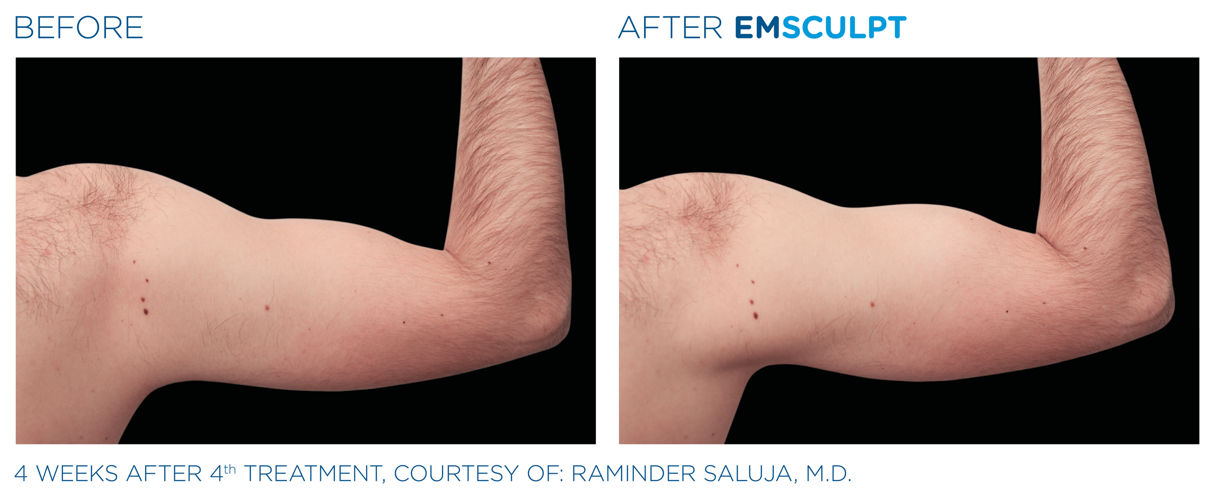 Emsculpt_PIC_Ba-card-male-arms-079_EN100.png