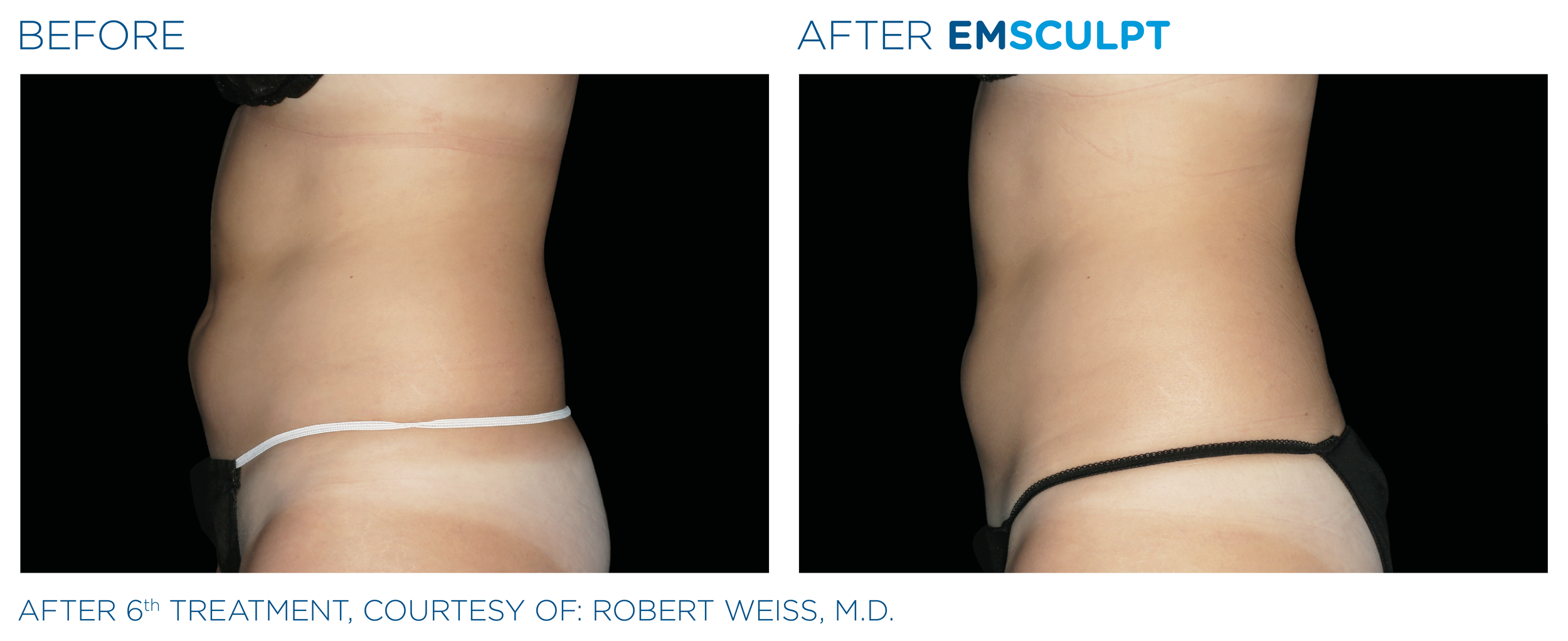 Emsculpt_PIC_Ba-card-female-abdomen-010_EN100.png