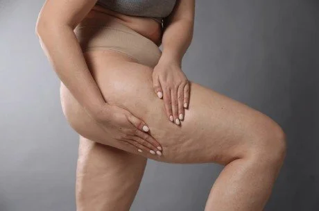 Cellulite.jpg