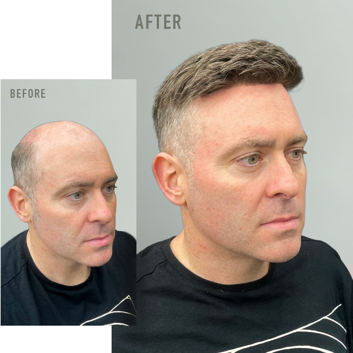Side-by-side comparison of before and after hair restoration, showing a man with a balding scalp in the "before" image and a full head of hair in the "after" image.