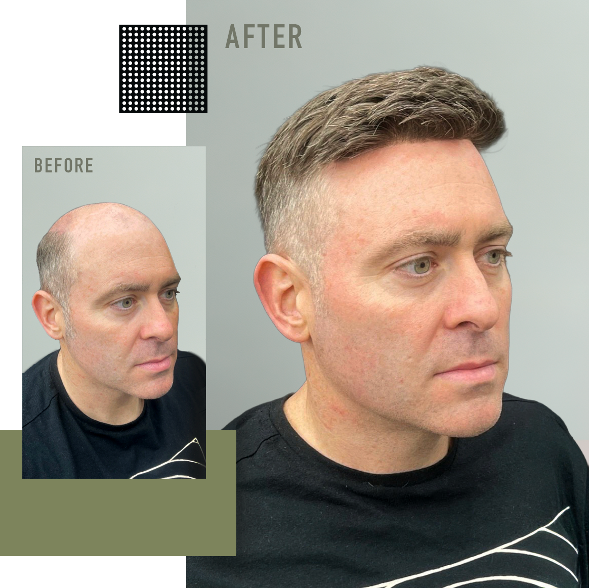 Side-by-side comparison of a man's hair before and after a Ethos barbershop non-surigical hair replacement service. The "before" image shows him with a shaved and prepared scalp, and the "after" image shows him with a full head of styled hair.