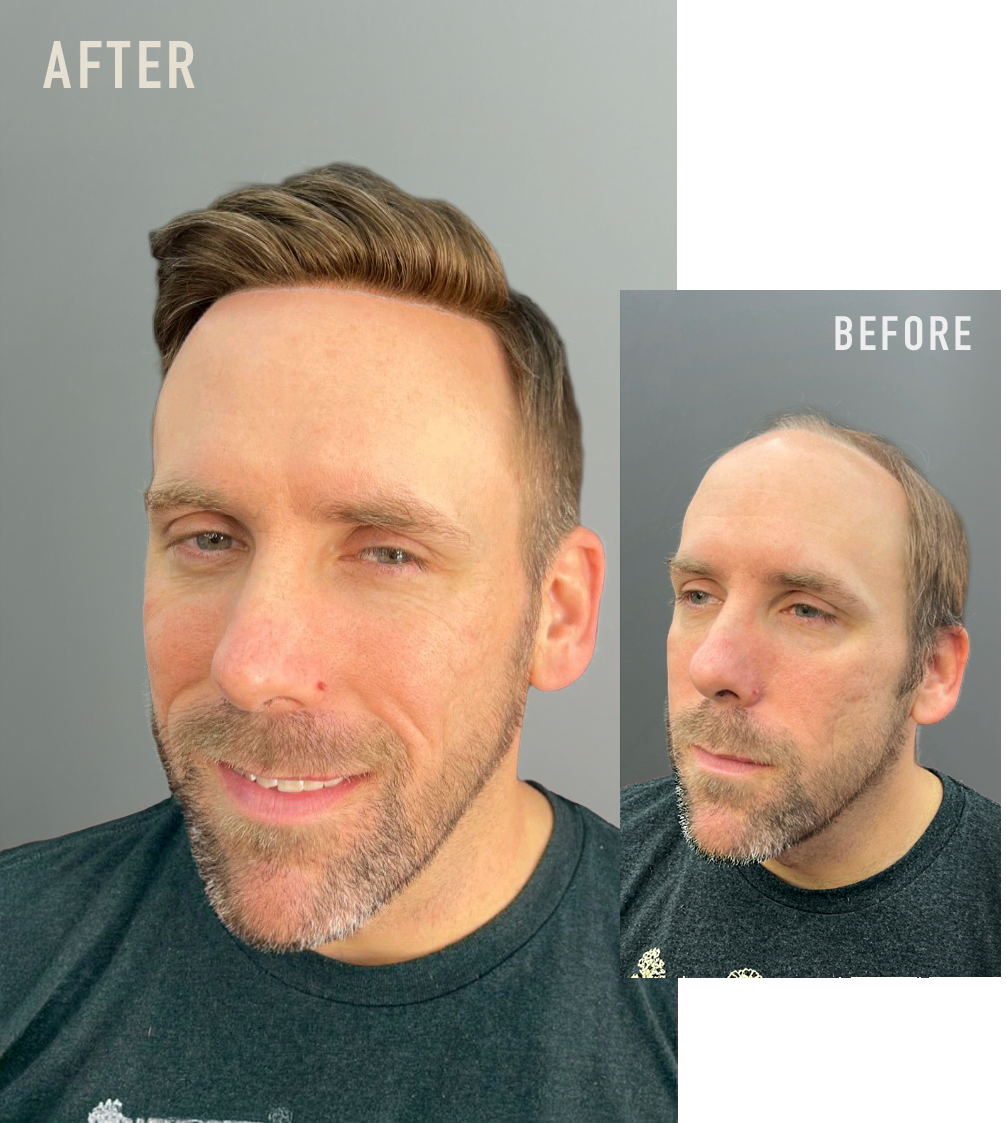 Before and after comparison photos of a man showing non-surgical hair replacement results, with the word 'AFTER' on the larger image on the left and 'BEFORE' on the smaller inset image on the right.