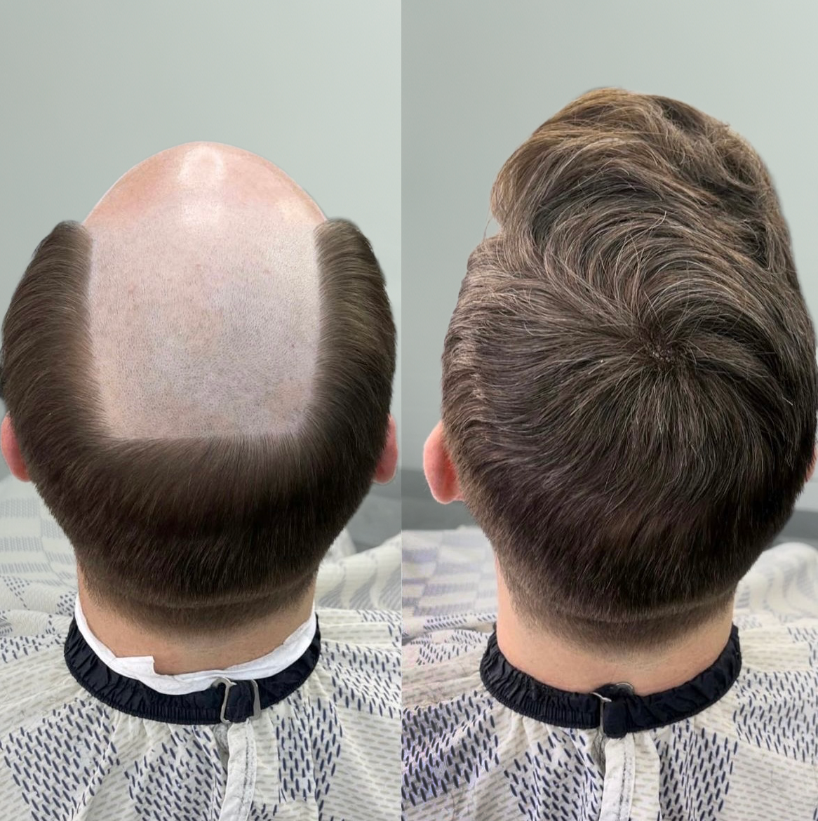 Comparison of a man's hair before and after hair restoration treatment, showing a bald head on the left and a full head of styled hair on the right.