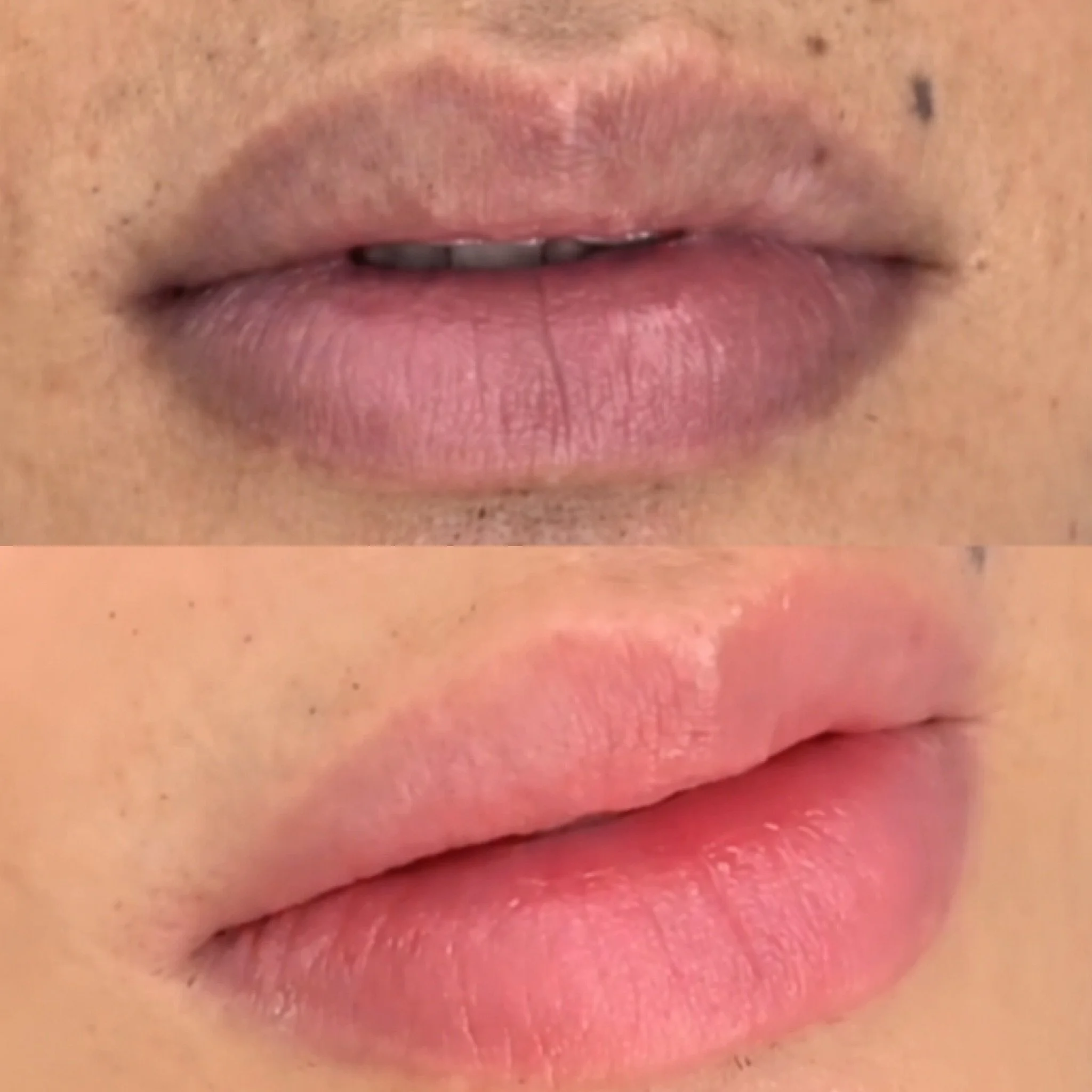 Healed lip blush results after dark lip colour correction.#lipblushsydney #sydneylipblush #lipblush #lipneutralisation #darklipneutralization darklipcorrection healedlipblush lipblushtattoo naturallips pinklips luxurybeauty pmulips permanentmakeup sy