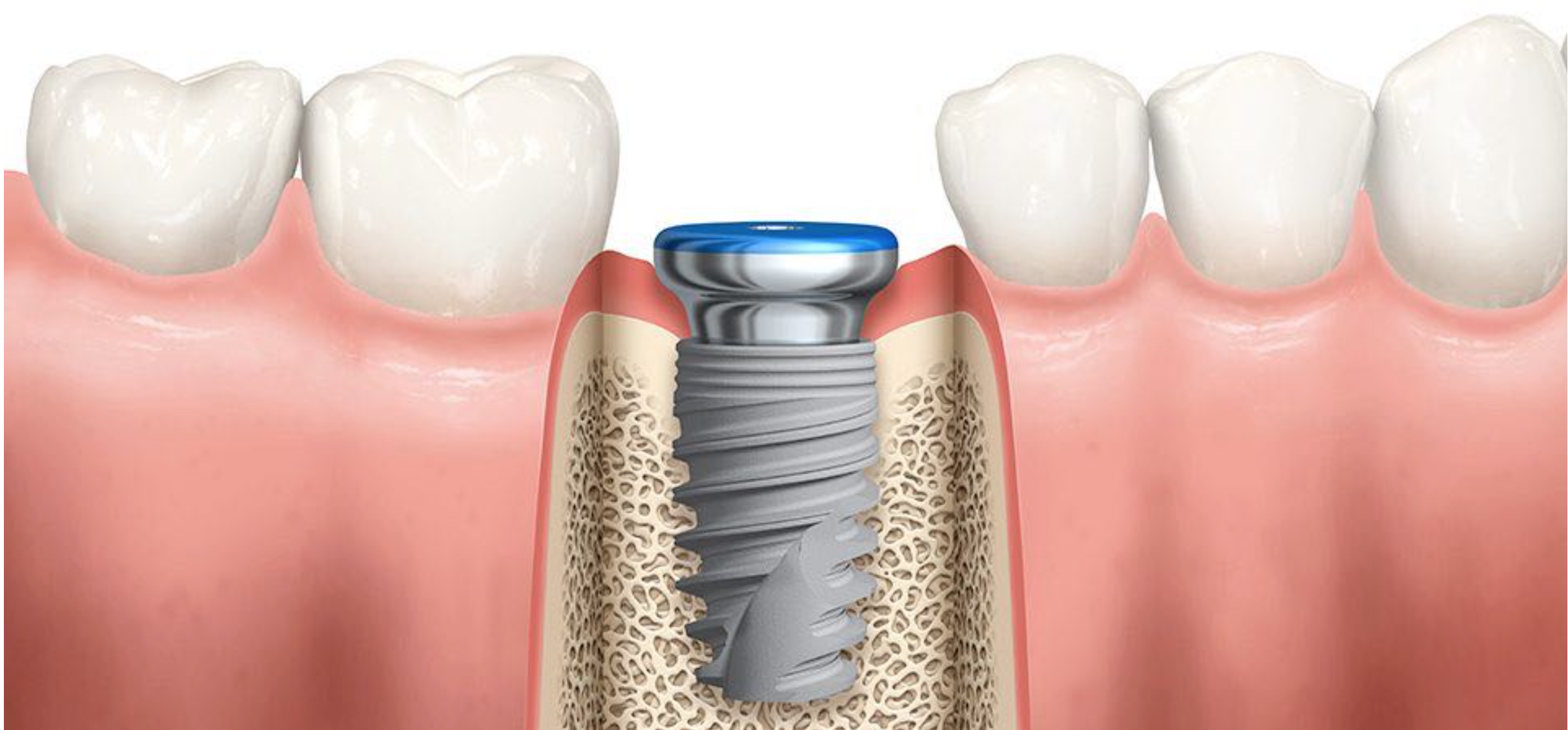 Diagramma di un impianto dentale con vite in titanio inserita nell'osso mascellare, circondata da gengive e denti naturali visibili.