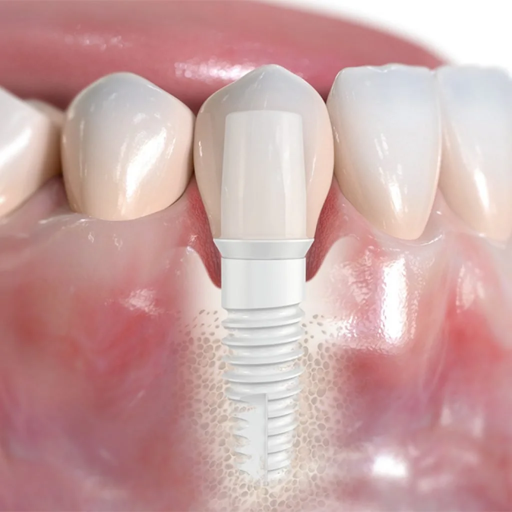 Immagine di un impianto dentale con corona dentale sopra un dente naturale.