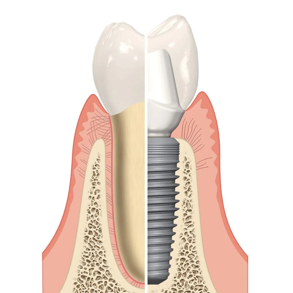 Diagramma che mostra un dente naturale a sinistra e un impianto dentale con vite a destra
