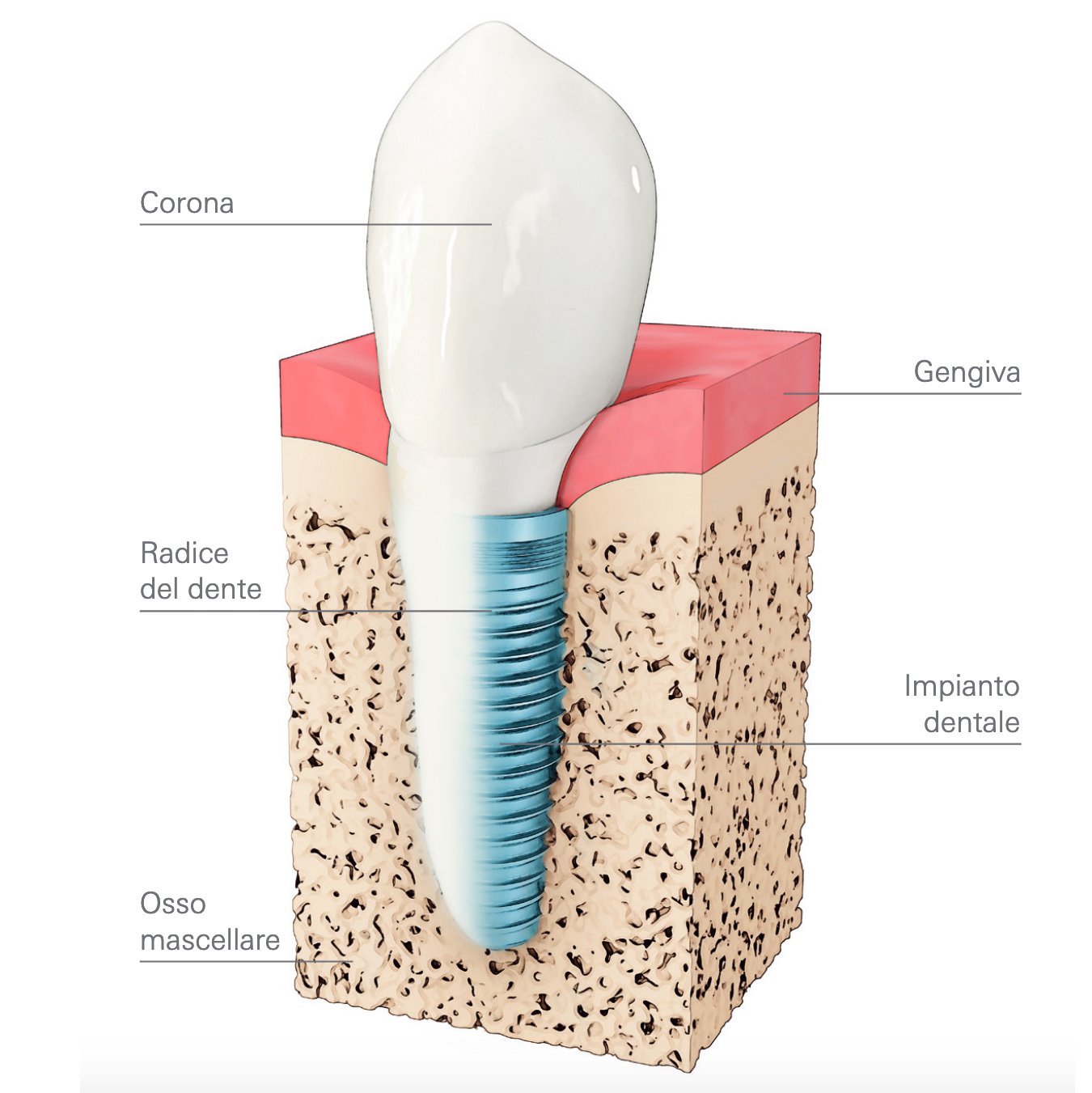 Diagramma di un impianto dentale con etichette in italiano: corona, gengiva, radice del dente, impianto dentale, osso mascellare.