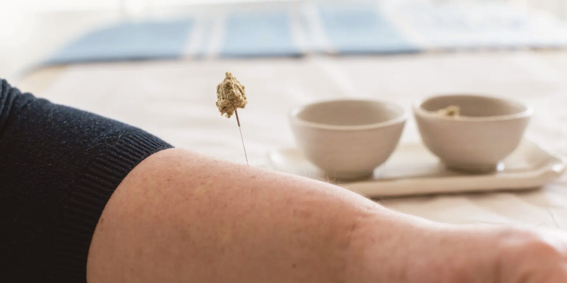 A close-up of a person's arm with a needle and a cotton ball, used for acupuncture or injection, near two white bowls on a tray in the background.