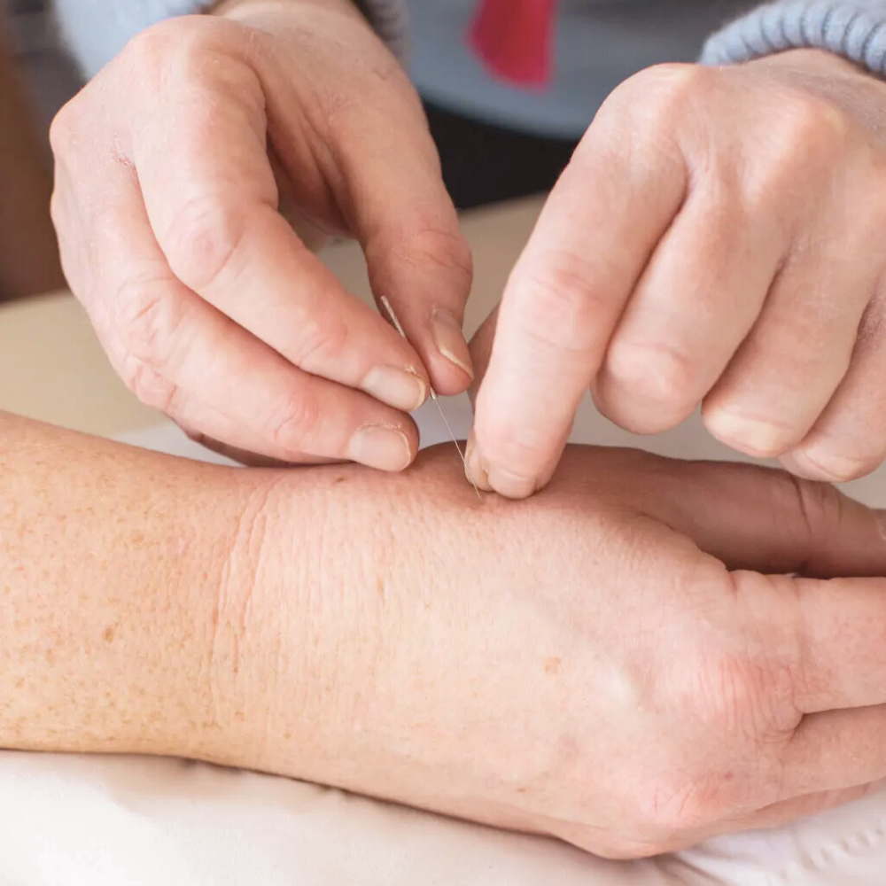 Person administering acupuncture by inserting a thin needle into the forearm of a patient.