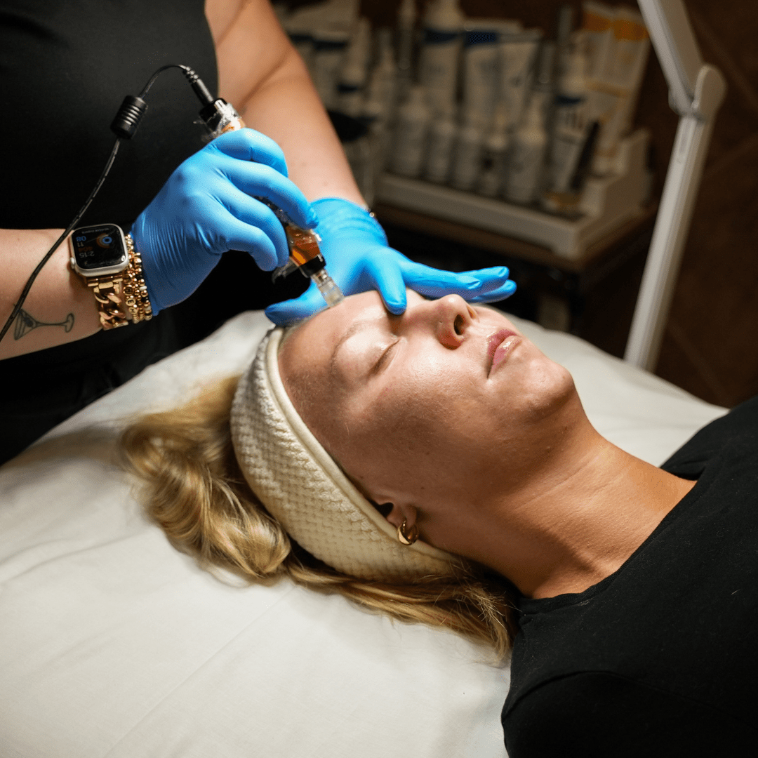woman receiving microneedling treatment