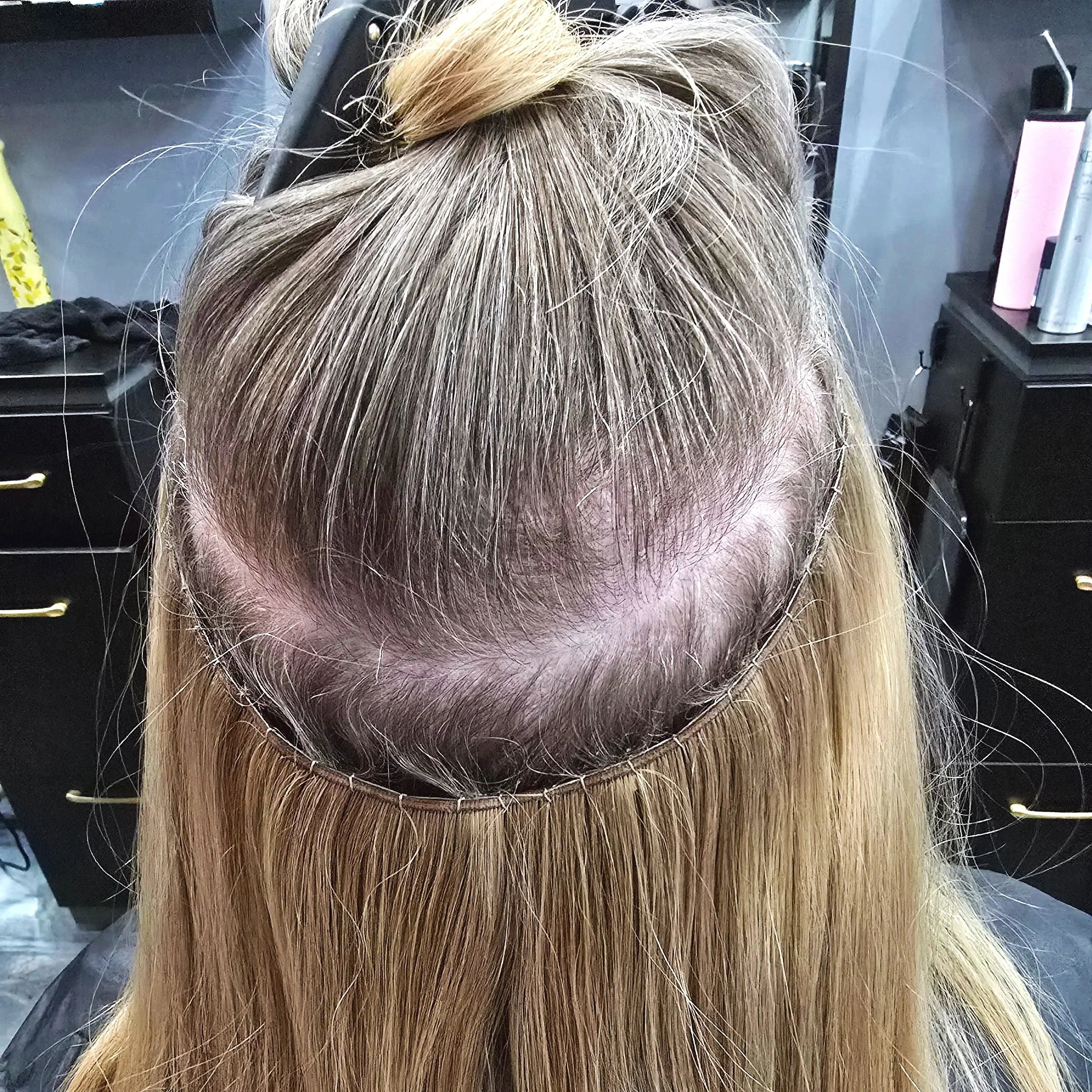 Back view of a person with blonde hair, showing a scalp with a hair transplant in progress, with a circular band securing the hair grafts.