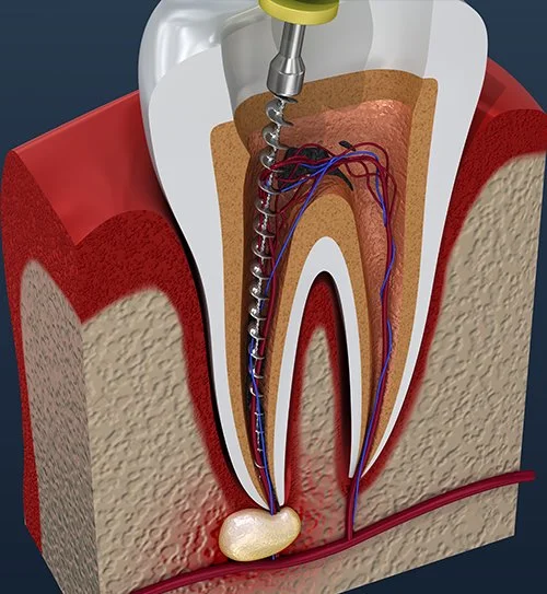 Cross-sectional illustration of a tooth showing root canal treatment and infected pulp removal.