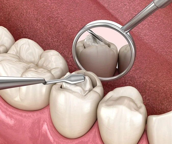 Dental illustration showing a cavity repaired with a tooth-colored filling.