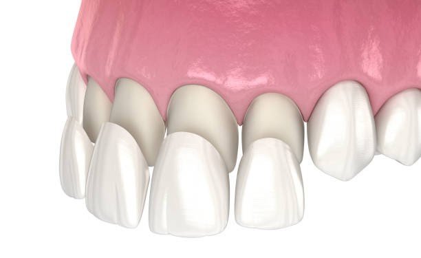 Illustration showing porcelain veneers bonded to the front of teeth to improve appearance.