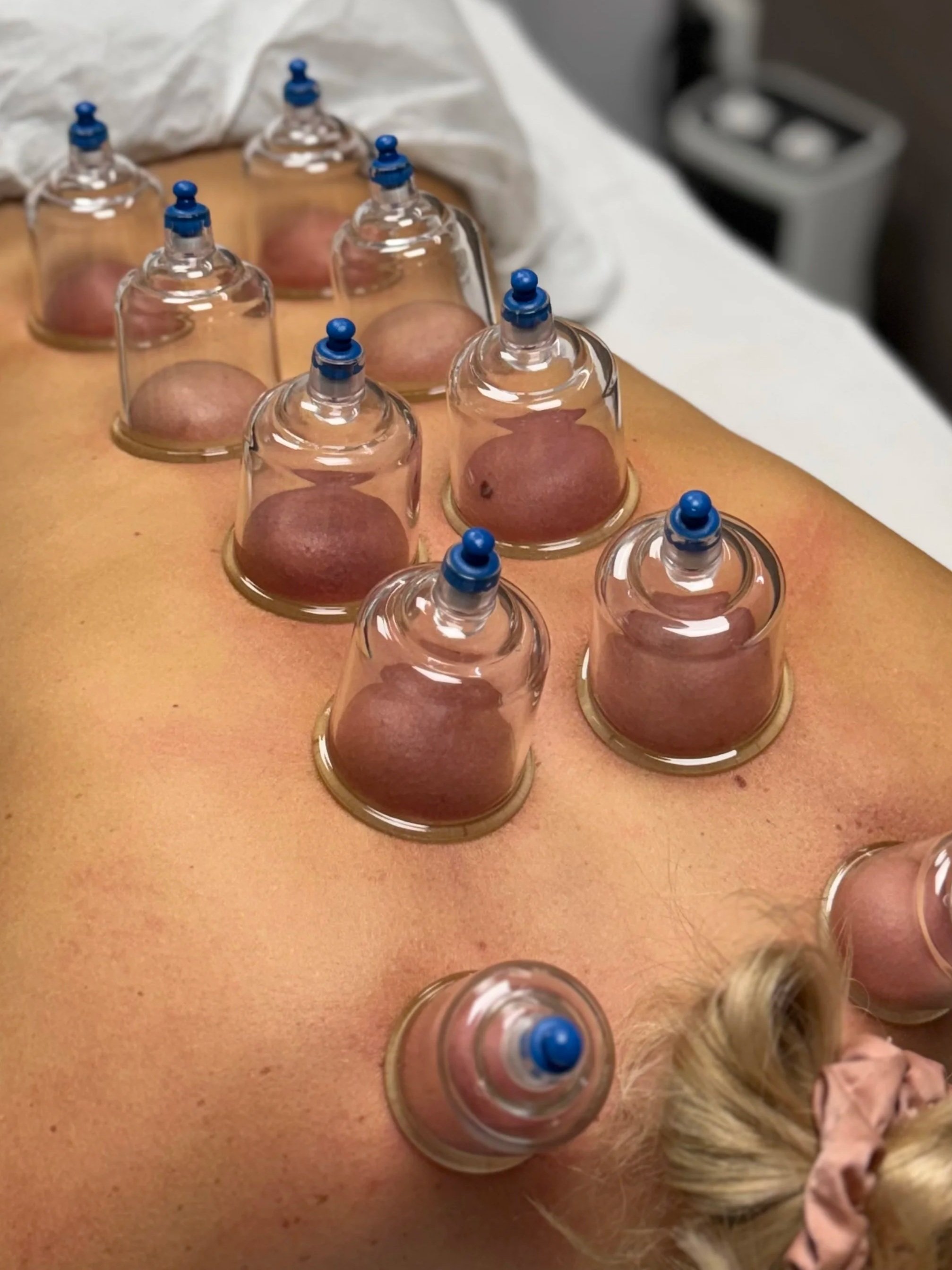 Trattamento di terapia con coppe di vetro sul dorso di una persona.