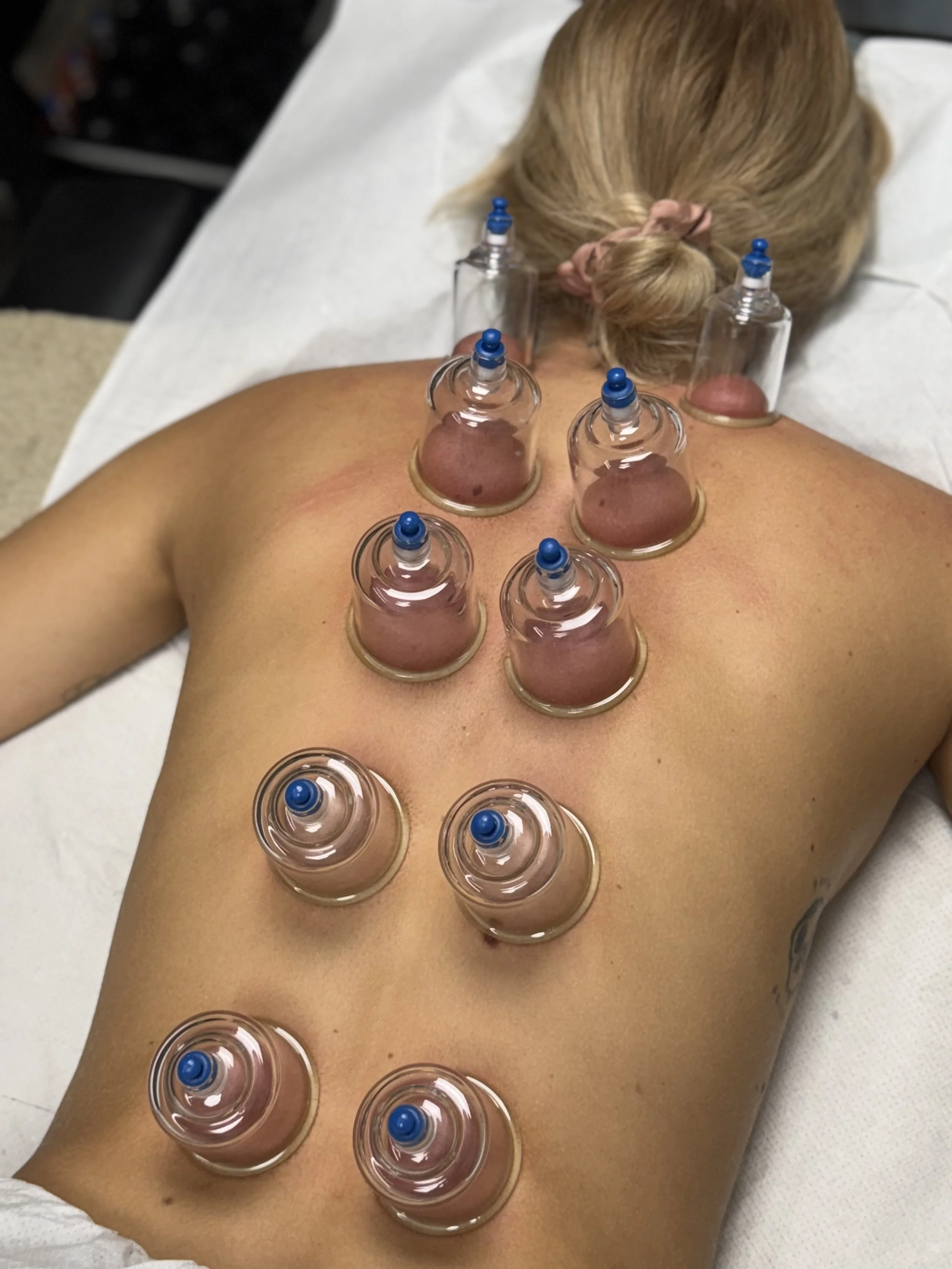 Una donna sdraiata su un lettino mentre riceve una sessione di coppettazione sul dorso, con diverse coppette di plastica trasparente applicate.