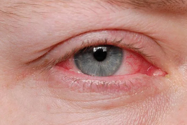 Close-up of a human eye with a blue iris and slightly red eyelids.