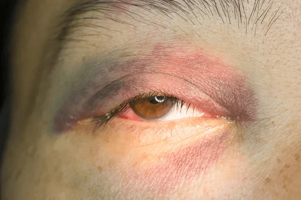 Close-up of a person's eye with red and irritated skin around the eyelid.