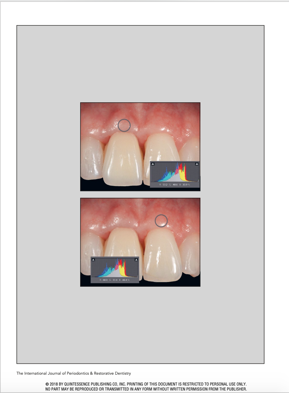 Flapless Postextraction Socket Implant Placement, Part 3 The Effects of Bone Grafting &amp; Provisional Restoration on Soft Tissue Color Change - A Retrospective Pilot Study