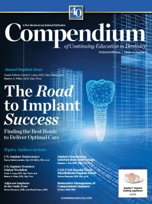 A Paradigm Change in Macro Implant Concept: Inverted Body-Shift Design for Extraction Sockets in the Esthetic Zone