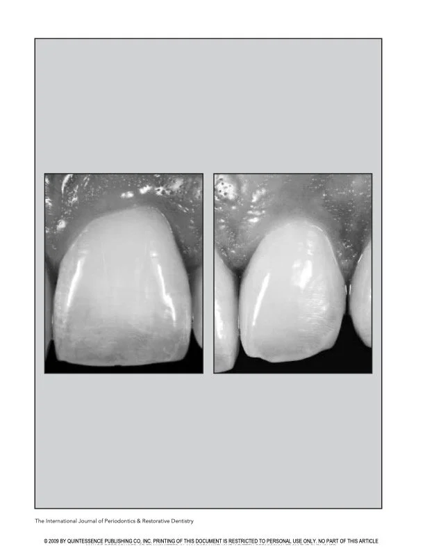 Papilla proportions in the maxillary anterior dentition