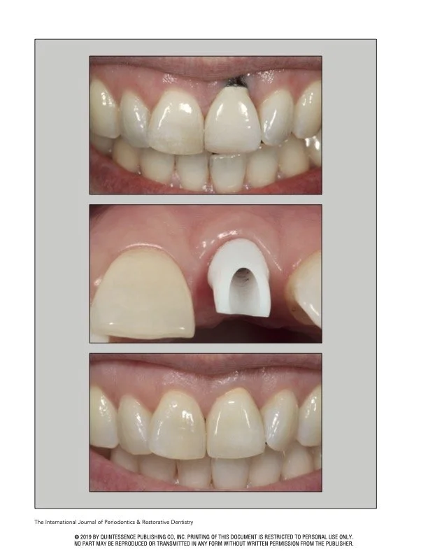 Restorative Emergence Profile for Single-Tooth Implants in Healthy Periodontal Patients: Clinical Guidelines and Decision-Making Strategies