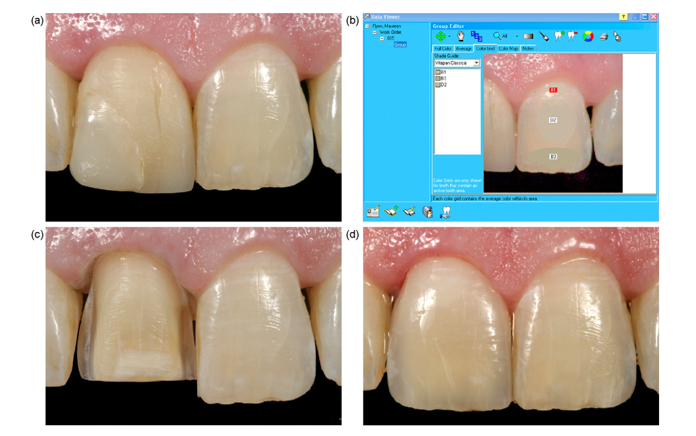 Dental color matching instruments and systems. Review of clinical and research aspects