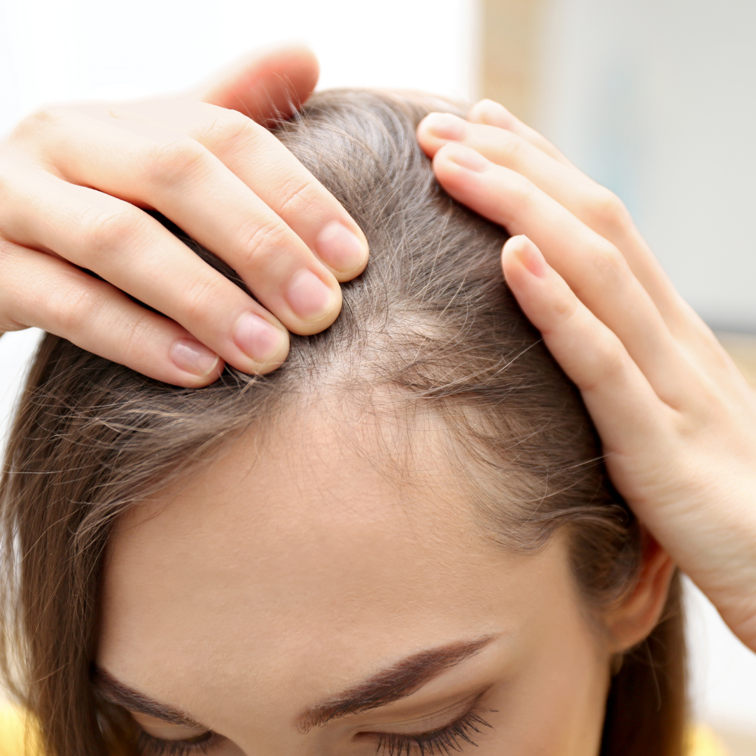 Understanding Female Pattern Baldness and How Acupuncture Can Aid in Hair Regrowth