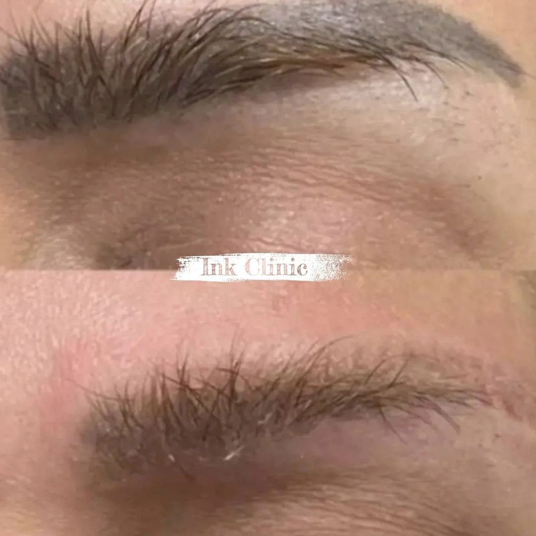 Remoção de micropigmentação