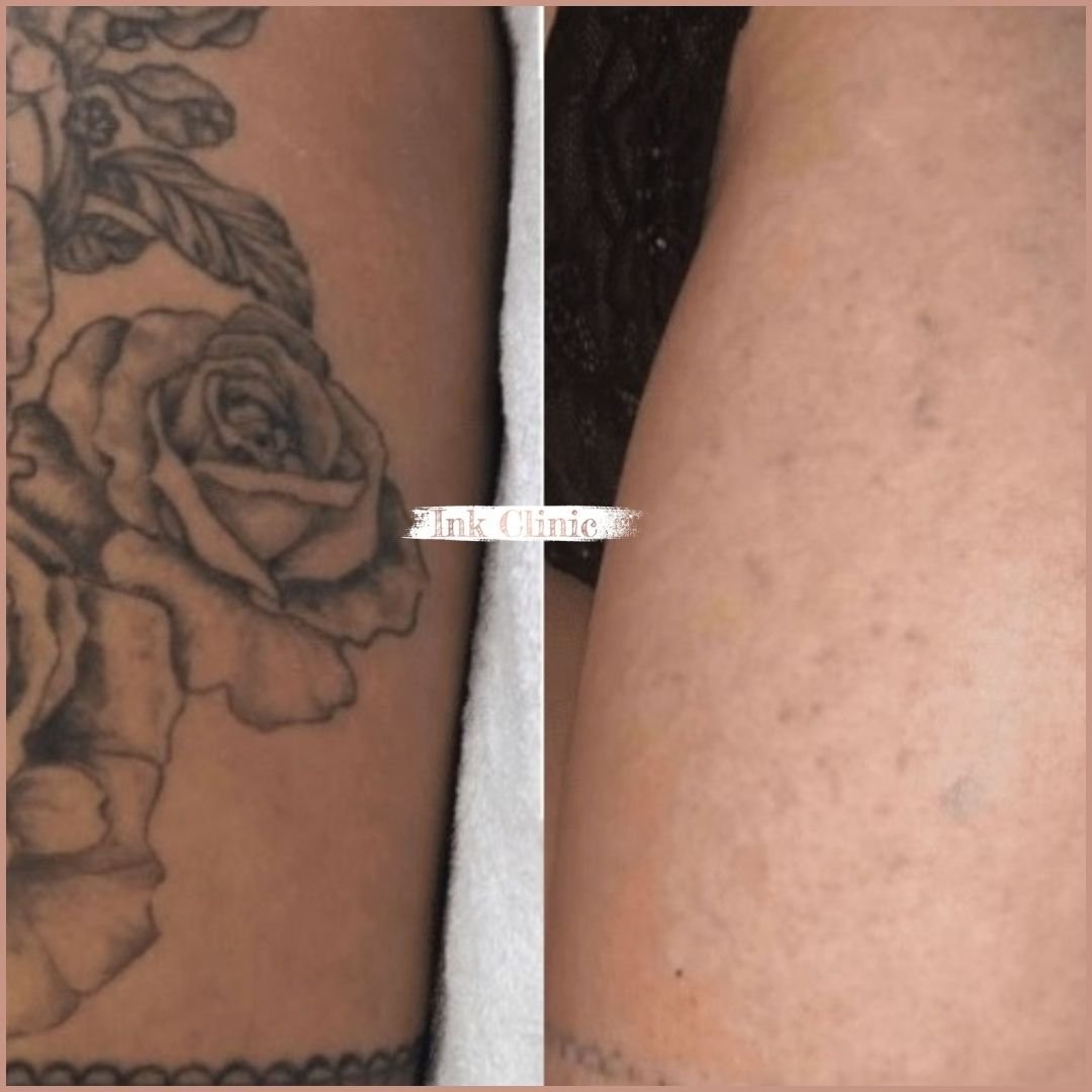 Quanto custa remover uma tatuagem? A verdade completa sobre preços e custos reais