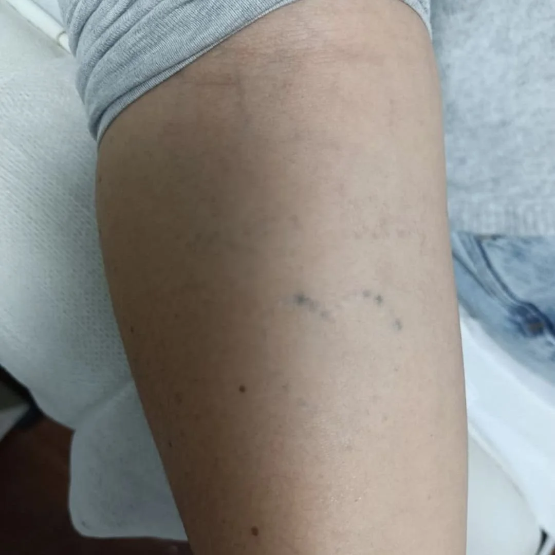 A remoção de tatuagens deixa cicatriz?