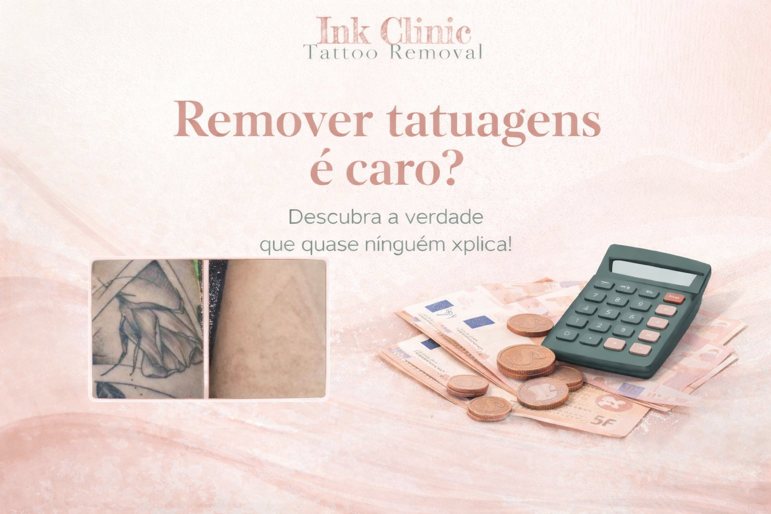 Remover tatuagens é caro em Portugal?