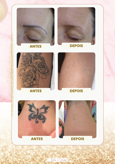 Remoção de tatuagens antes é depois com in clinic