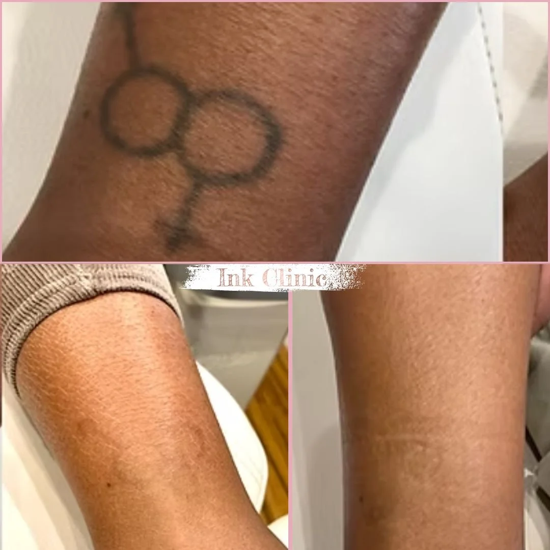 Tattoo removal in ink clinic