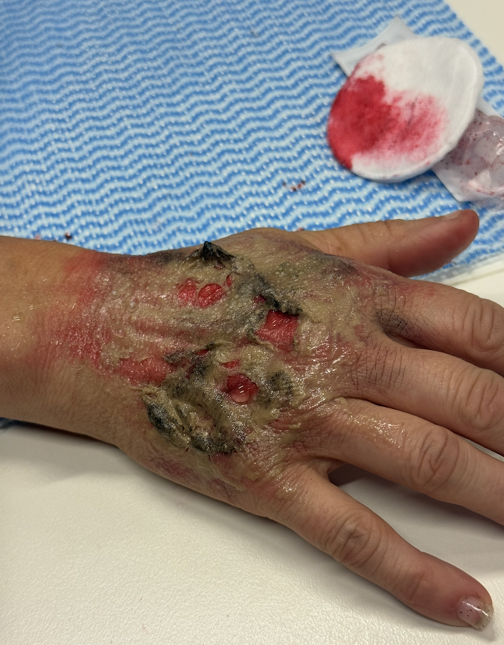 A hand with severe, burn injury showing open wounds, blackened skin, and blistered areas. Medical supplies are visible in the background.